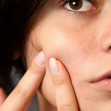 9 Simple DIY acne treatments by skin type