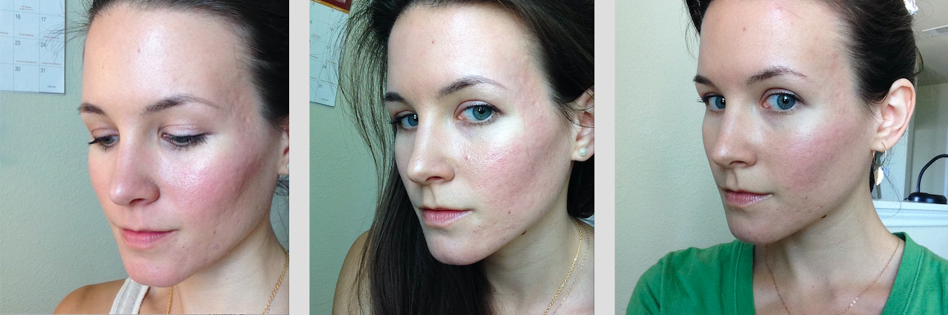 Derma Roller Before and After pictures showing noticeable improvement on acne scars 
