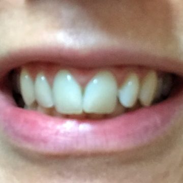 teeth1