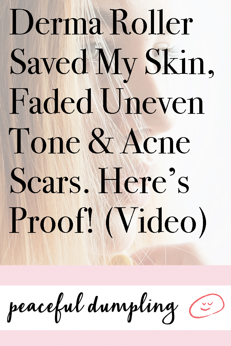 Derma Roller Saved My Skin, Faded Uneven Tone & Acne Scars. Here’s Proof! (Video)